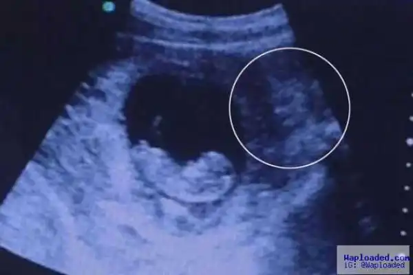 Photo Of Demon Watching Over Unborn Baby In Ultrasound Scan Wents Viral